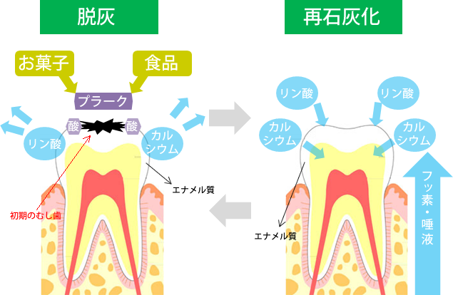 <h4>フッ素の動き</h4>
<p>ミネラル沈着を促進し、歯の再石灰化が行なわれる<br />
歯質強化により歯を酸から守る<br />
むし歯予防に効果的<br />
酸の生成を抑制</p>
<h4>フッ化物応用の種類</h4>
<p>フッ化物応用法は大きく分けて、「全身応用」と「局所応用」があります。<br />
・全身応用：フッ化物を直接飲み込んで体内に取り込む方法<br />
・局所応用：フッ化物を直接歯に作用させる方法</p>
<h4>フッ化物応用（局所応用）の種類によって効果は違う！</h4>
<p>フッ化物の種類や使い方によって効果はことなりますが、どの方法でも早くはじめて長く続けることが大切です。またいくつかのフッ化物応用を併用することで大きな予防効果が期待できます。</p>
<h4>永久歯のむし歯予防効果</h4>
<p>・フッ化物洗口 50％～80％<br />
・フッ化物歯面塗布 30％～40％<br />
・フッ化物入り歯磨き剤 20％～30％</p>
<h4>フッ素洗口</h4>
<p>フッ素ナトリウム含有の溶液で口をゆすぎます。抵抗力のある歯へと導き、むし歯を予防します。</p>
<p>特にお子様（４歳頃）のときから開始するとその効果も大きいといわれています。（大人の方でも適しています。）</p>
